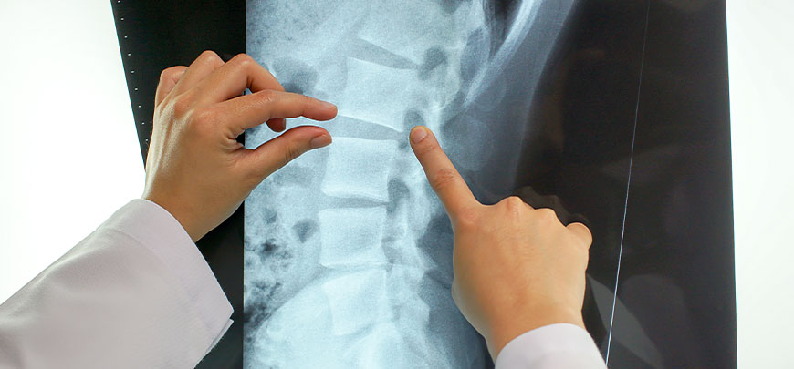 Patient with a slipped disc in need of spinal decompression therapy at Leucadia Chiropractic & Disc Injury Clinic in Encinitas